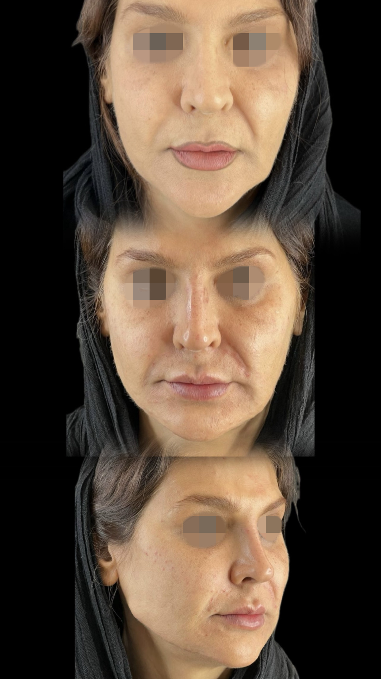 نمونه کار تزریق فیلر فک قبل و بعد - تصویر 1 - زاویه سازی فک با فیلر