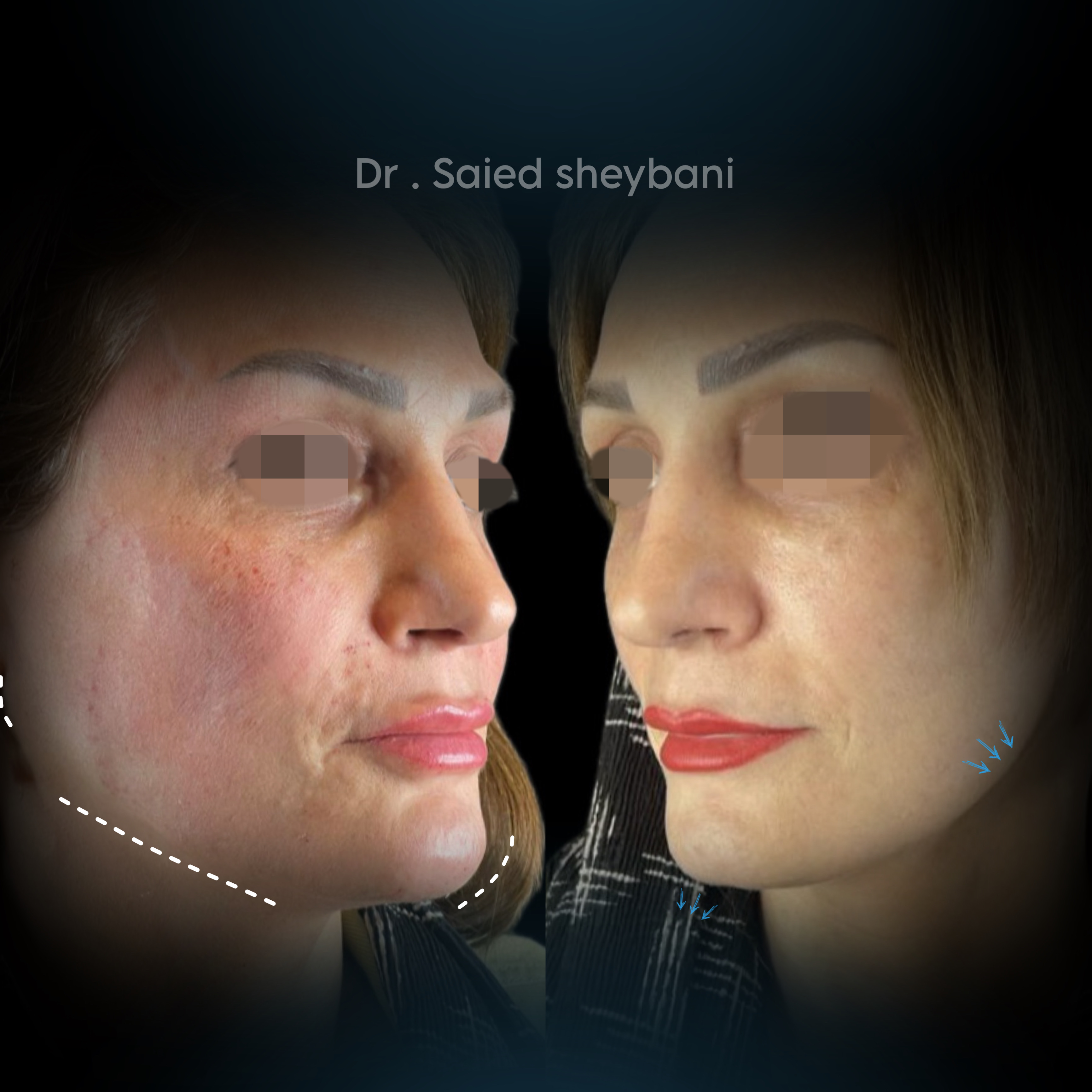 نمونه کار تزریق فیلر فک قبل و بعد - تصویر 2 - ژل خط فک